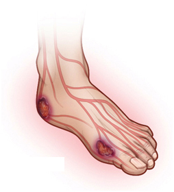 Diabetic Foot Ulcer Treatment India offers info on Affordable Diabetic Foot Ulcer IND India, Efficacy Of RHPDGF Based Gel In Diabetic Foot Ulcers India