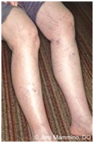 Spider Veins Treatment India offers info on Cost Spider Veins Surgeons Hospital India, Spider Veins Treatment India