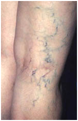 Varicose Veins Treatment India offers info on Cost Varicose Veins Treatment Hospital India, Varicose Veins Treatment India