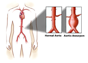 Aortic Aneurysm Repair Surgery offers info on Aortic Aneurysm Surgery India, Aortic Aneurysm Repair India, Safe Aortic Aneurysm Repair India