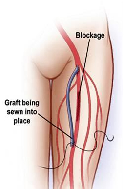 Peripheral Vascular Bypass Surgery India, Peripheral Bypass Surgery Information India